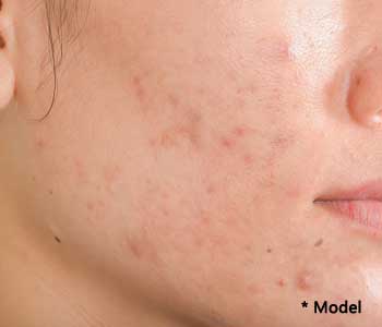 Ways of treating acne