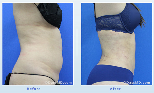 Dr. Dennis Dass, MD Liposuction by body area