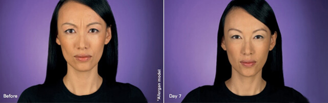 Botox before after image 1