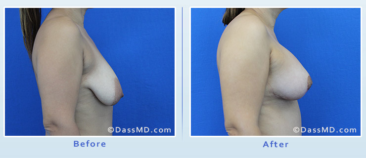Breast Reduction case 1 before after image 3