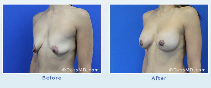 Breast Reduction case 2 before after image 2