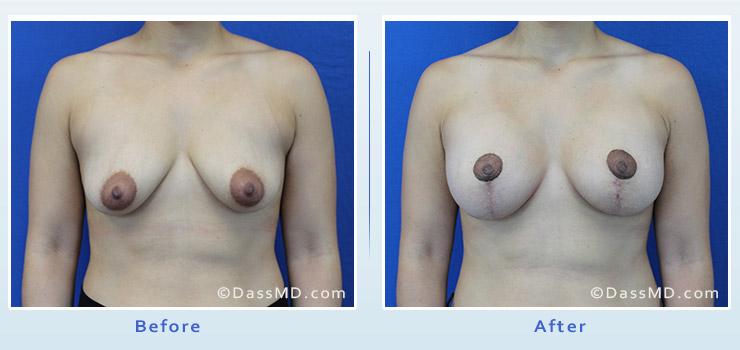 Breast Reduction case 3 before after image 1