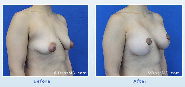 Breast Reduction case 3 before after image 2
