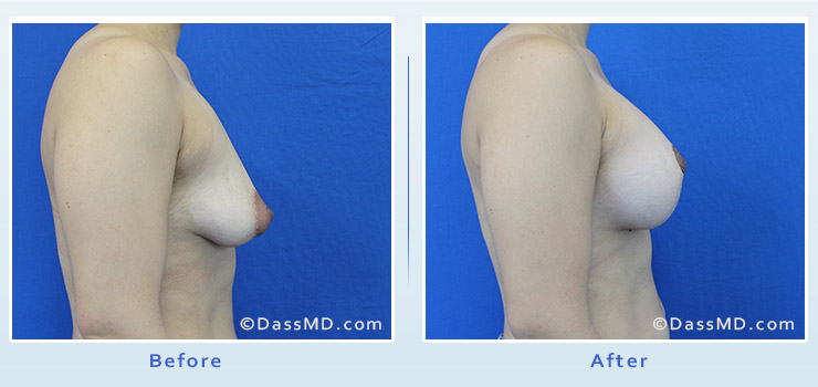 Breast Reduction case 3 before after image 3