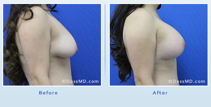 Breast Augmentation with Lift case 4 before after image 3