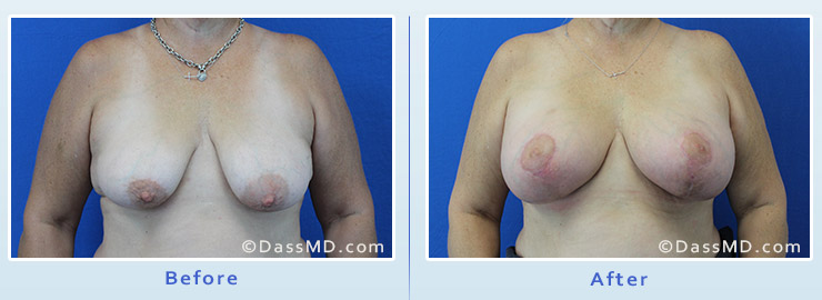 Breast Augmentation with Lift case 5 before after image 1
