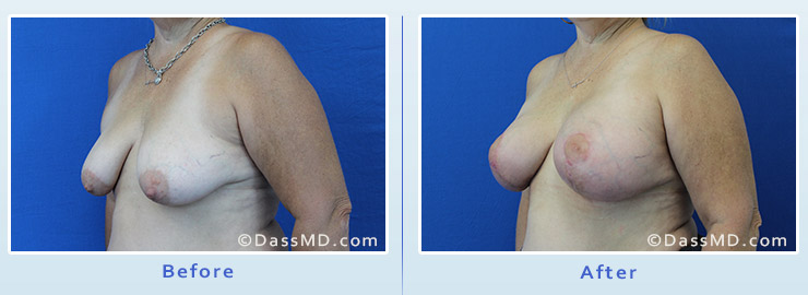 Breast Augmentation with Lift case 5 before after image 2