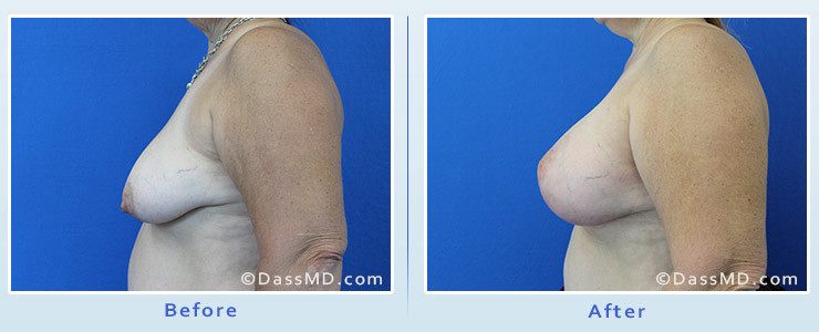 Breast Augmentation with Lift case 5 before after image 3