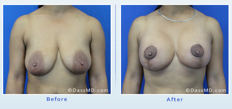Breast Augmentation with Lift case 6 before after image 1