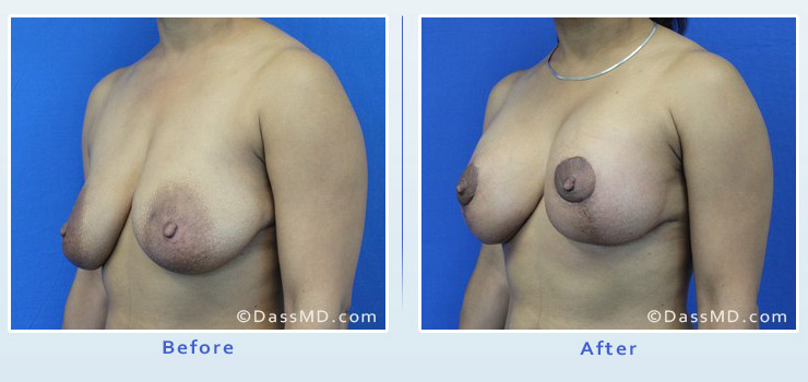 Breast Augmentation with Lift case 6 before after image 2
