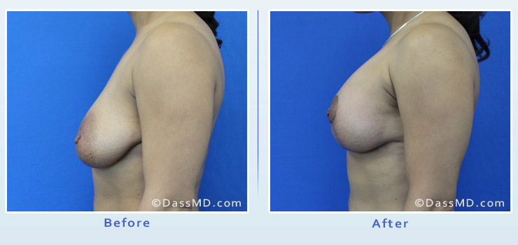 Breast Augmentation with Lift case 6 before after image 3