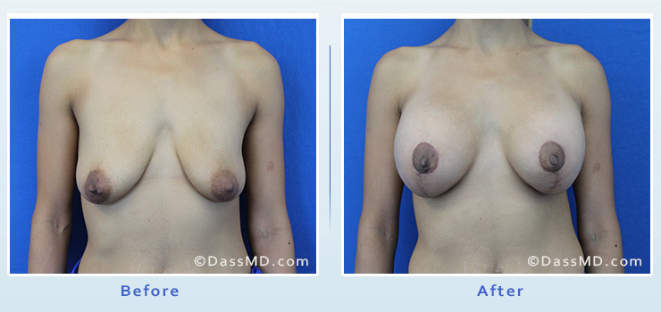 Breast Augmentation with Lift case 7 before after image 1