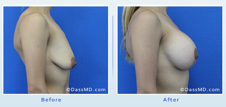 Breast Augmentation with Lift case 7 before after image 3