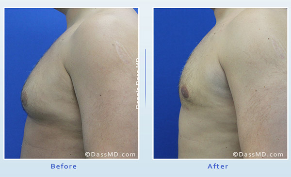 Dr. Dennis Dass, MD Chest Liposuction