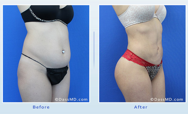 Dr. Dennis Dass, MD Liposuction fat transfer to buttock