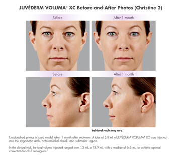 Juvederm before after image 1