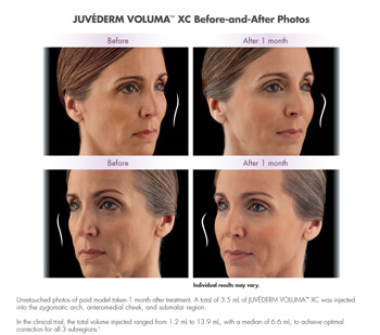 Juvederm before after image 3