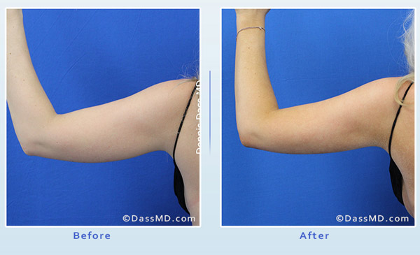 Dr. Dennis Dass, MD Arm Liposuction