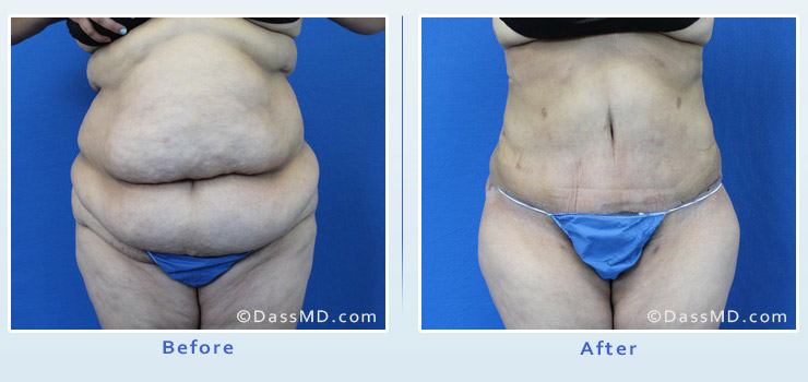 Beverly Hills extreme transformation case 1 before after image 1