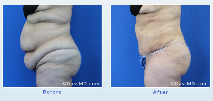 Beverly Hills extreme transformation case 1 before after image 3