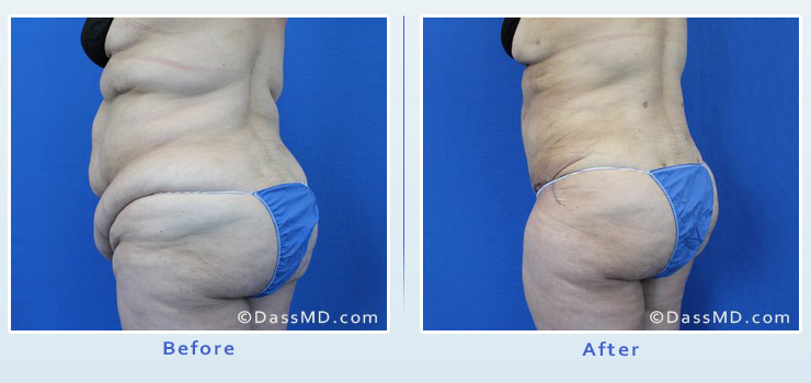 Beverly Hills extreme transformation case 1 before after image 4