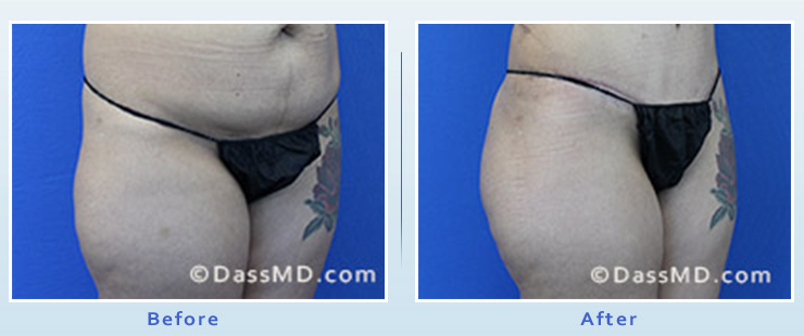 Actual Tummy Tuck before and after Results