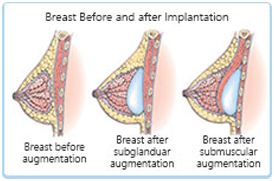 Breast Augmentation diagramtic explanataion 1