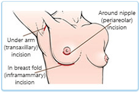 Breast Augmentation diagramtic explanataion 3