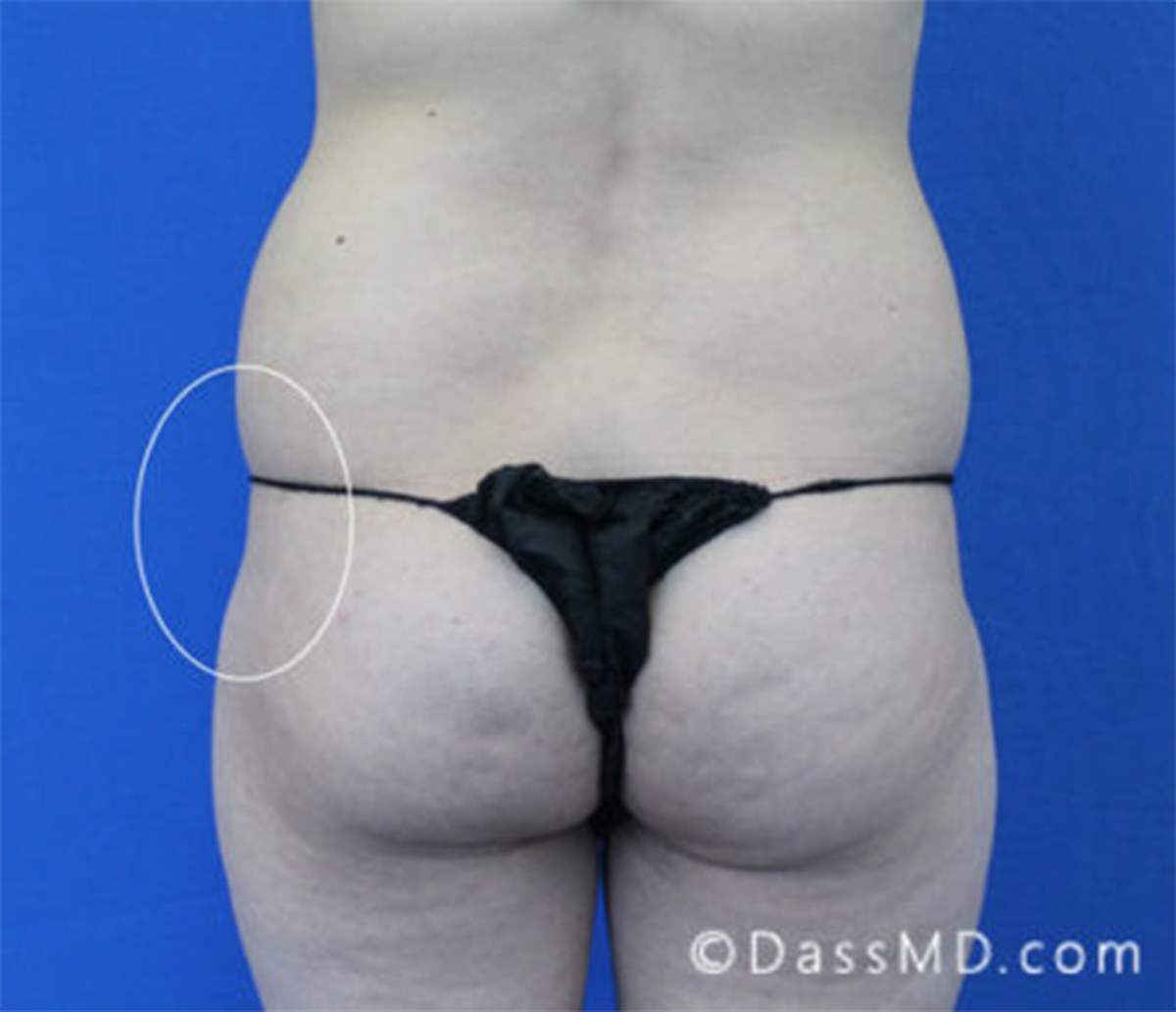 Treatment of hip dips with fat transfer from Dr. Dass in Los Angeles, CA
