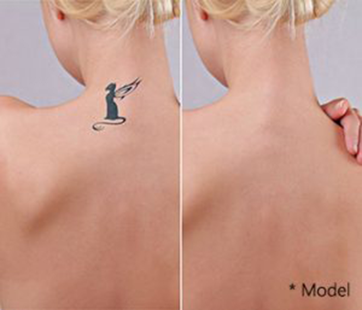 Beverly Hills area plastic surgeon offers effective laser tattoo removal