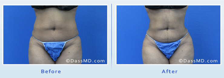 Beverly Hills Liposuction of Waist & Hips Results - Before & After View