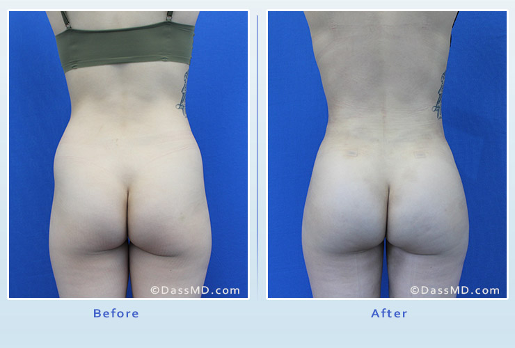 Fat transfer buttock augmentation for thin women case 2 before after image 1