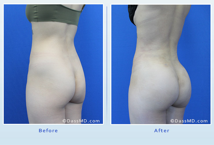 Fat transfer buttock augmentation for thin women case 2 before after image 2