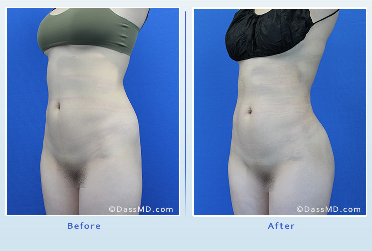 Fat transfer buttock augmentation for thin women case 2 before after image 4