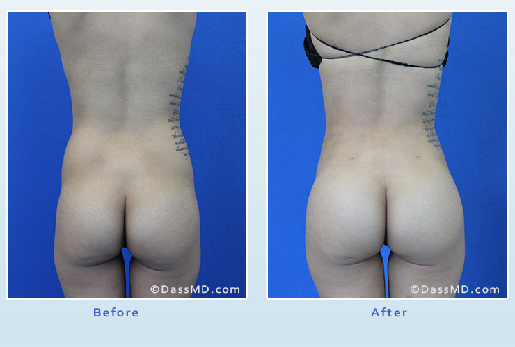 Fat transfer buttock augmentation for thin women case 1 before after image 1