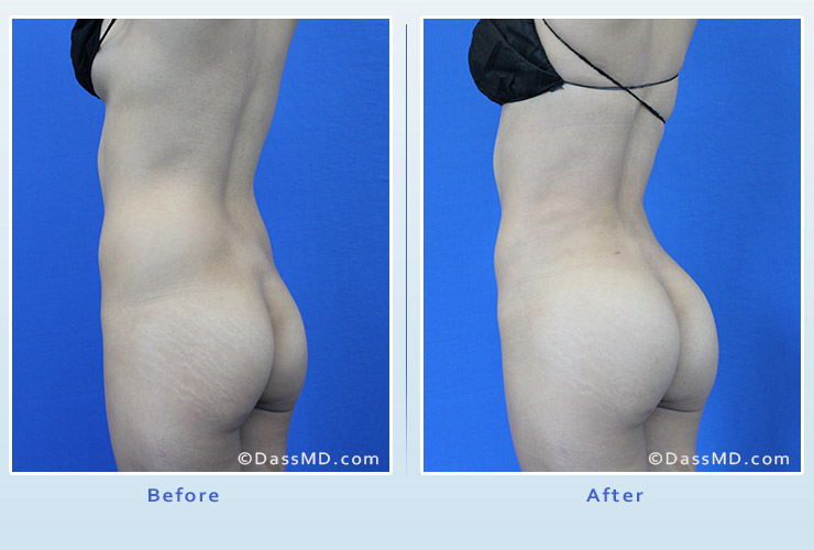 Fat transfer buttock augmentation for thin women case 1 before after image 2