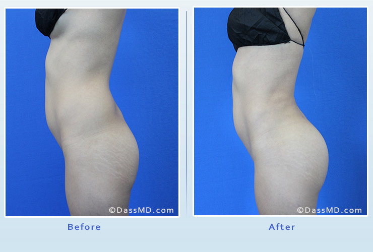 Fat transfer buttock augmentation for thin women case 1 before after image 3