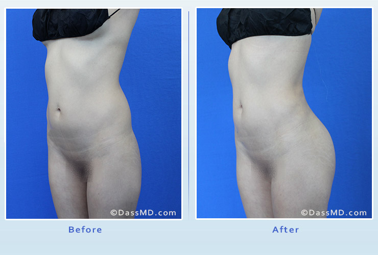 Fat transfer buttock augmentation for thin women case 1 before after image 4