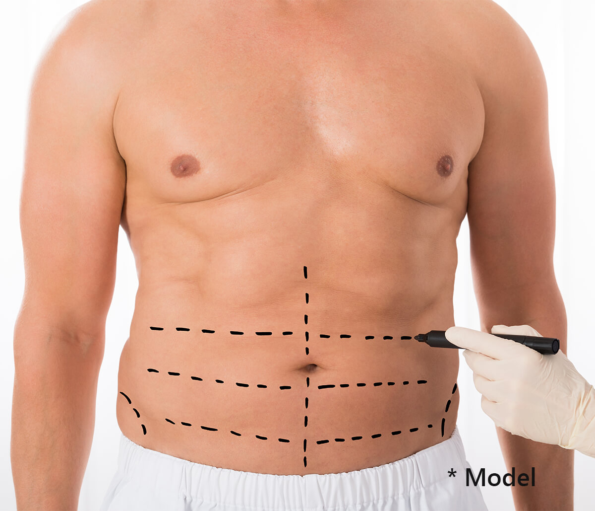 Liposuction for Men in Beverly Hills Area